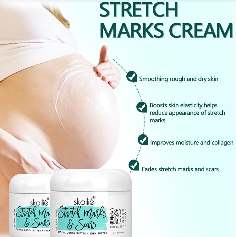 Do Stretch Marks Go Away If You Lose Weight?
